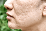 Acne Scar Treatment