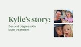 Second Degree Skin Burn Treatment - Kylies Story