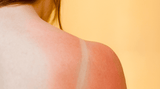 Sunshine and Skin Conditions - Hanna Sillitoe