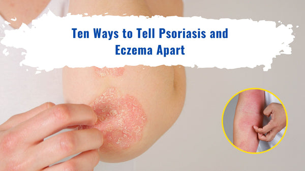 Ten Ways to Tell Psoriasis and Eczema Apart