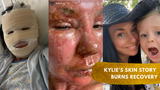 Second Degree Skin Burn Treatment - Kylies Story