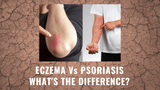 Eczema vs Psoriasis What's The Difference