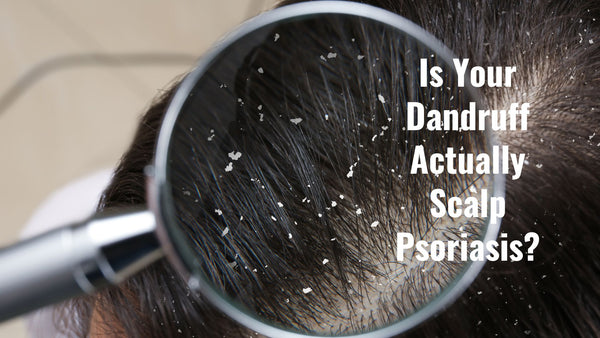 Is Your Dandruff Actually Scalp Psoriasis?
