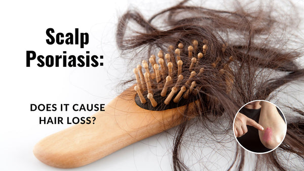 Scalp Psoriasis: Does It Cause Hair Loss?