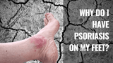 Why Do I Have Psoriasis on My Feet?