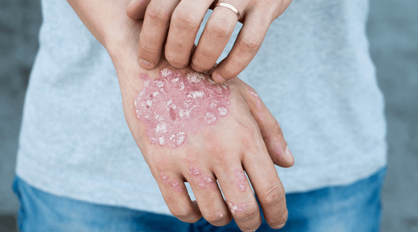 Is Psoriasis Curable?