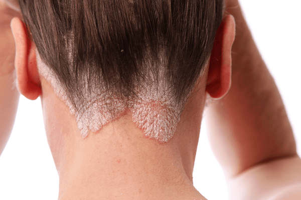 Psoriasis in Hair