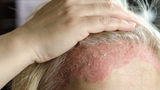 Psoriasis in Hair