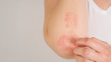 Is Psoriasis Contagious?