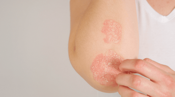 Is Psoriasis Contagious?