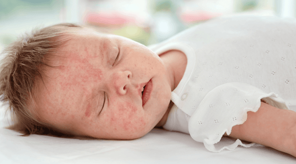 How to Soothe Children's Eczema